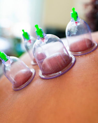 Hijama (Cupping)